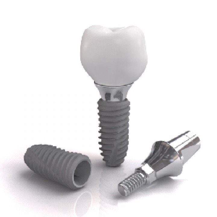 LỢI ÍCH KHI CẤY GHÉP IMPLANT NHA KHOA CÙNG DENTIUM